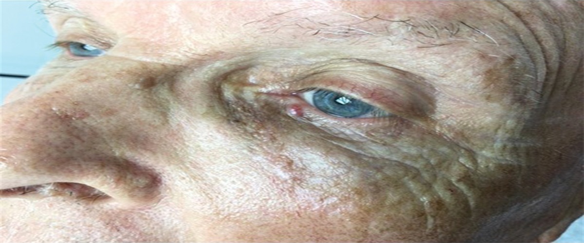 Eyelid Papule: Clinical Pathologic Challenge