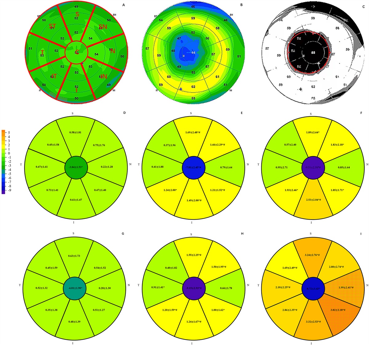 Short-term Changes in Epithelial and Optical Redistribution Induced by Different Orthokeratology Designs