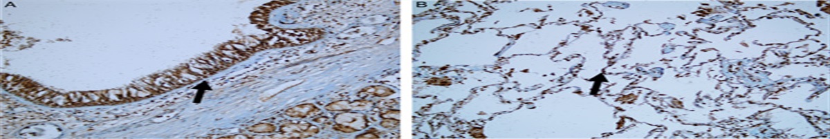 The Prognostic and Functional Impact of Sprouty 2 Expression in Non–small Cell Lung Cancer