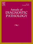 Prognostic implications of synaptophysin, CD56, thyroid transcription factor-1, and Ki-67 in pulmonary high-grade neuroendocrine carcinomas