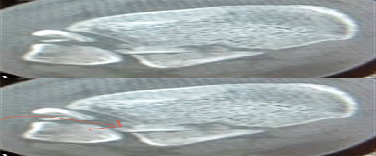 Comparison of Two Surgical Approaches for Trimalleolar Ankle Fracture Fixation