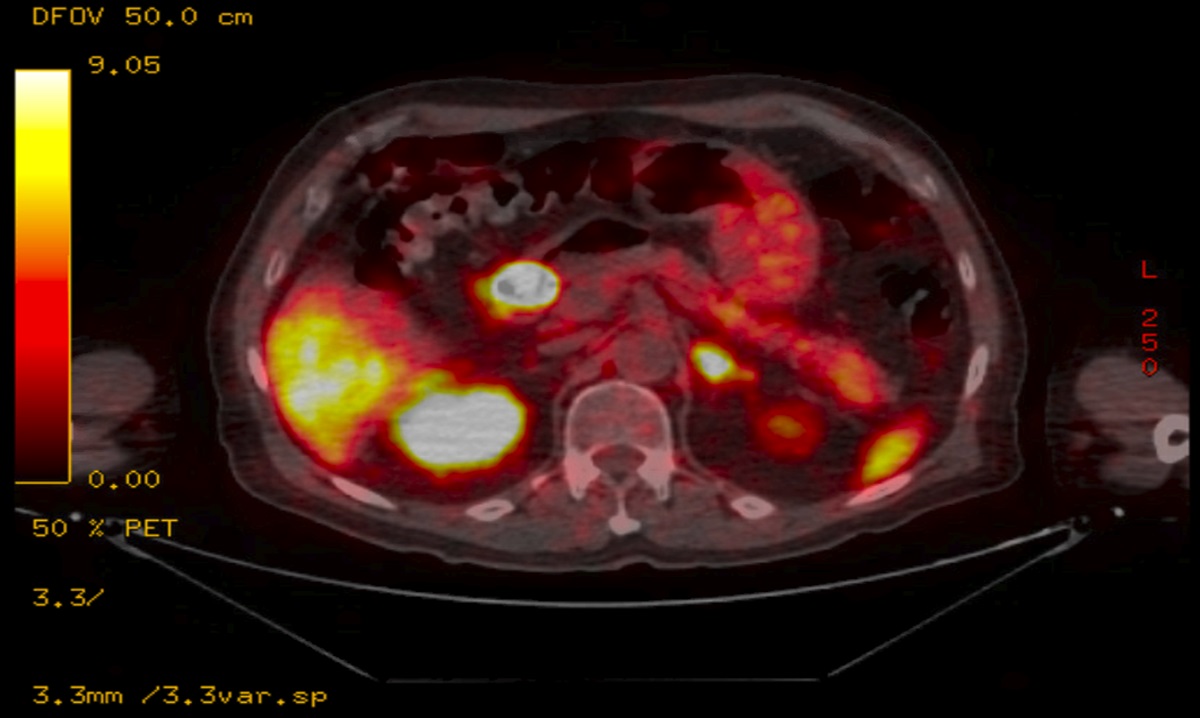 Complete Esophageal Obstruction: A Rare Complication of Zollinger-Ellison Syndrome