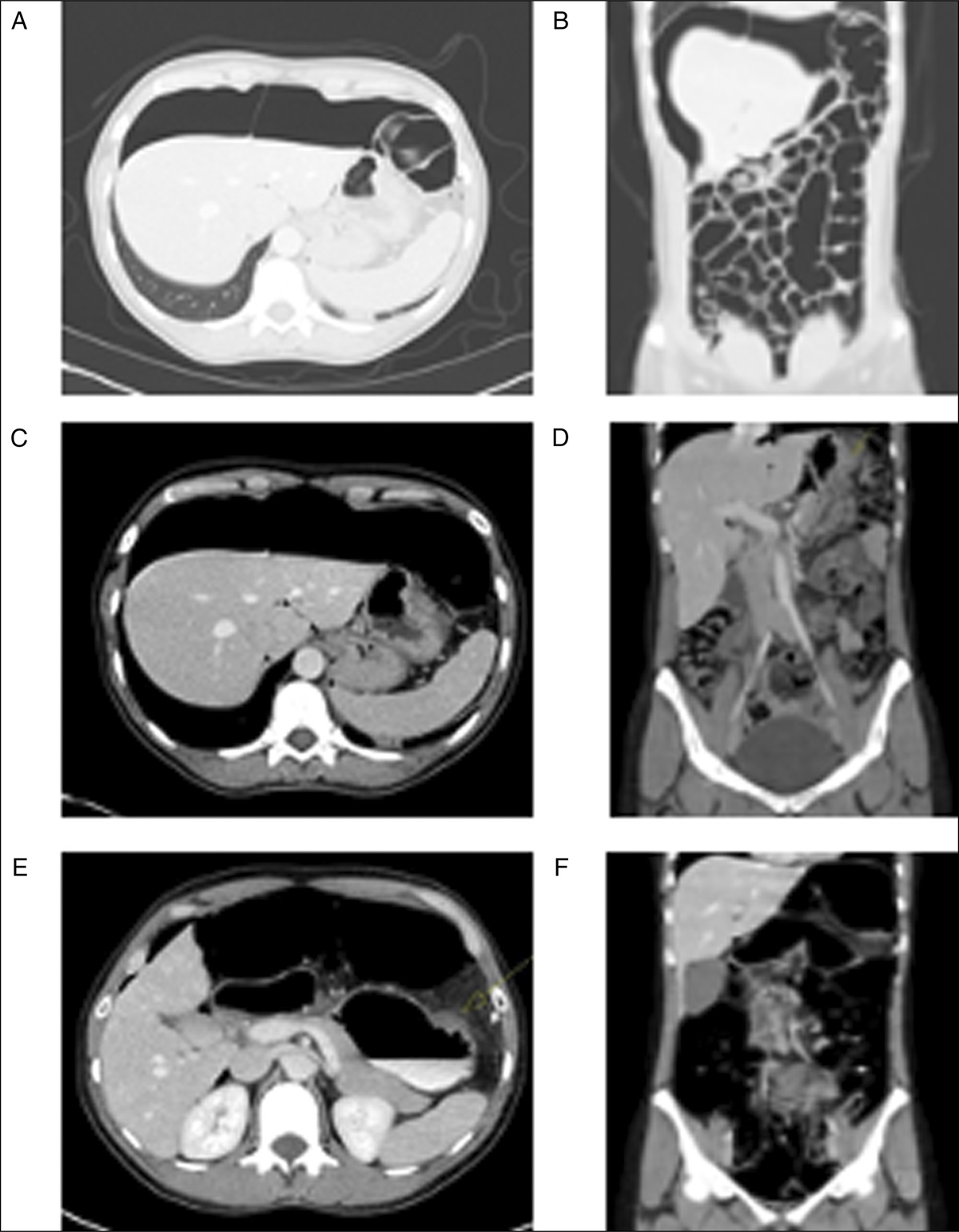 Idiopathic Spontaneous Pneumoperitoneum and Call for a Multi-Institutional Database
