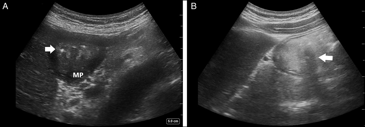Point-of-Care Ultrasound Image Interpretation: Gastric Thrombus Resembling a Full Stomach