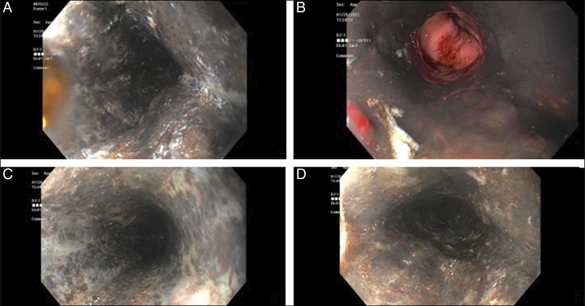 An Unusual Case of Black Esophagus