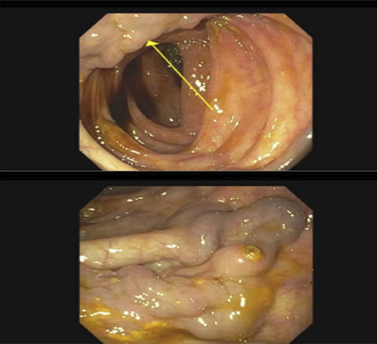 Isolated Colonic Varices in Pancreatic Adenocarcinoma