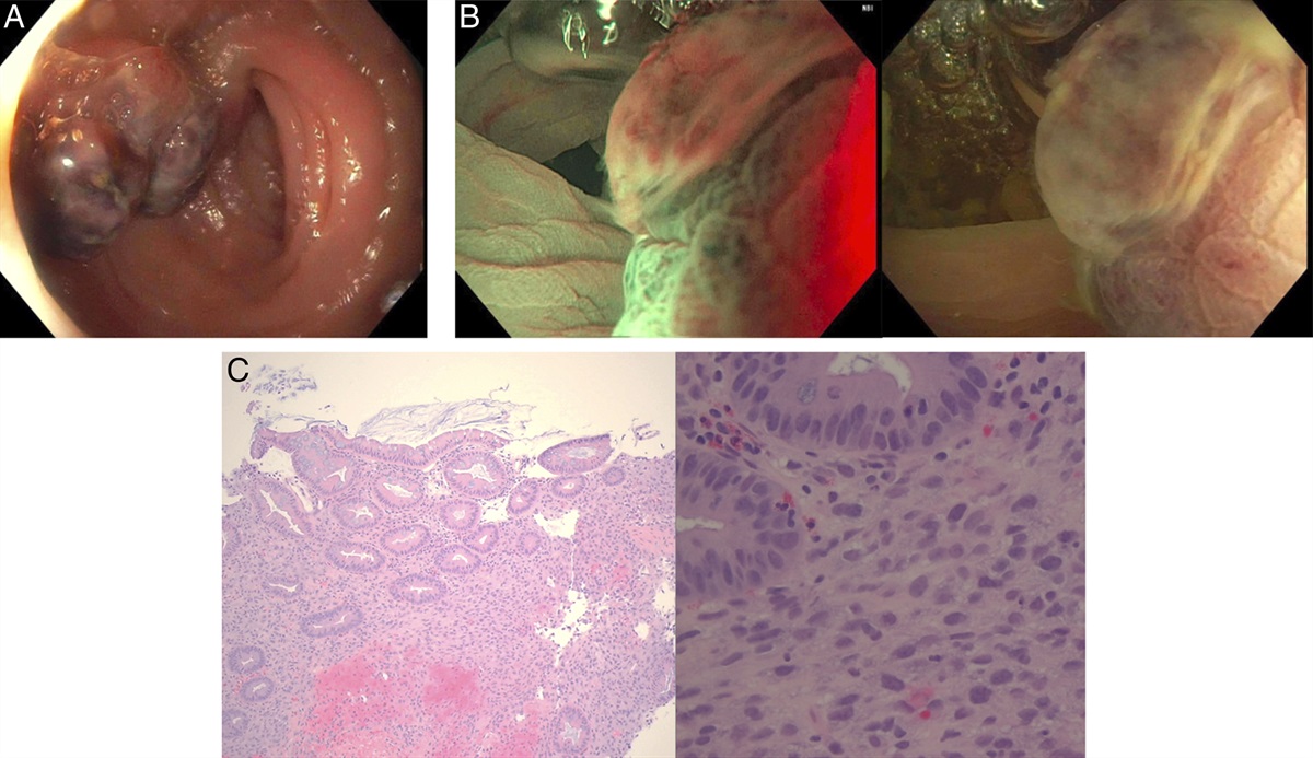 Thyroid Metastasis to the Colon