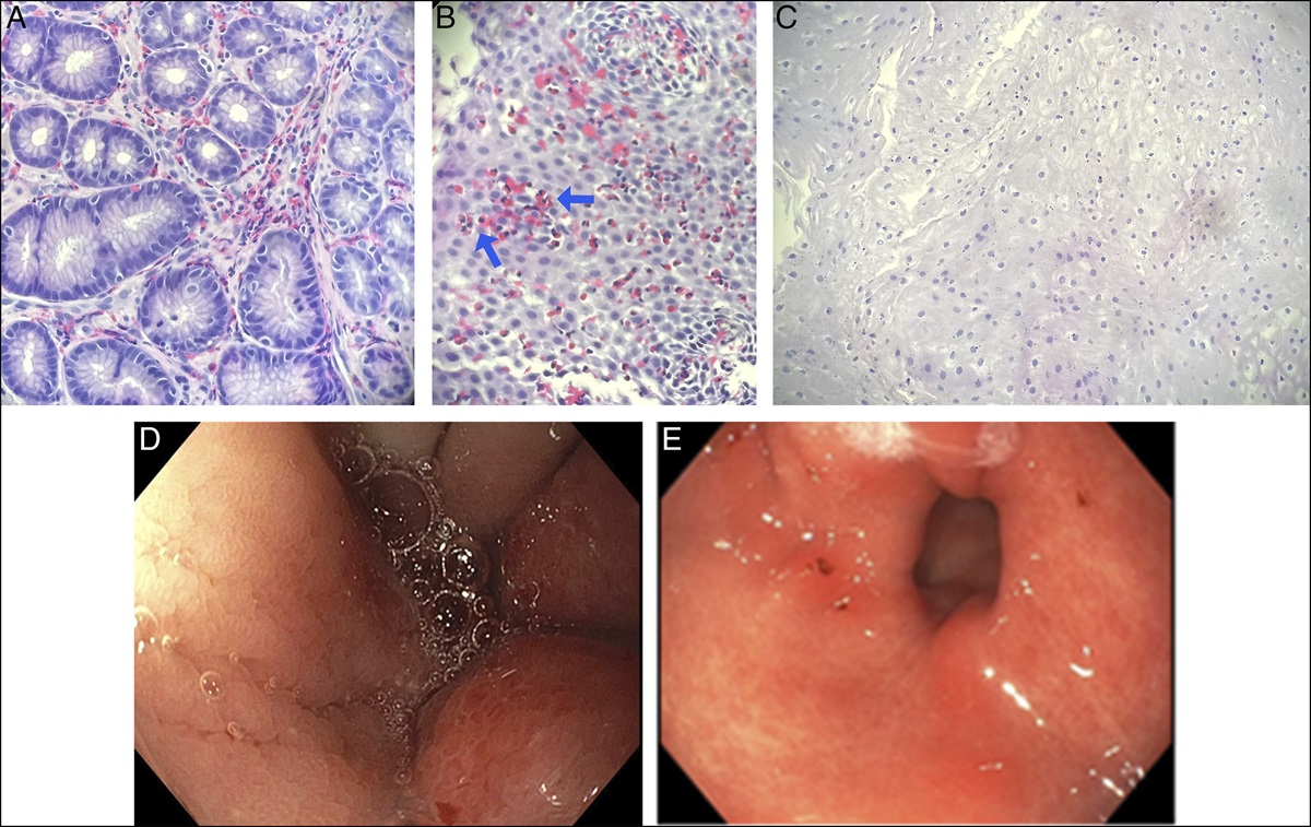 A Case of Refractory Eosinophilic Gastrointestinal Disease Successfully Treated With Dupilumab