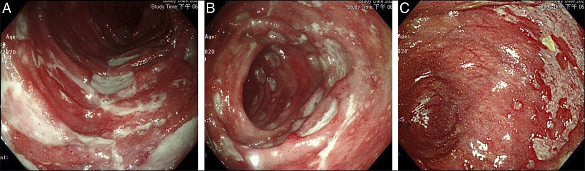 Dual Biologic Therapy for Refractory Crohn's Disease With Perforation in a Patient Declining Surgical Intervention