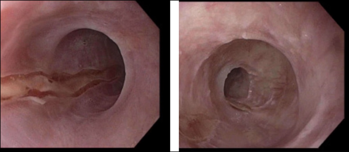 Use of Upadacitinib in Refractory Esophageal Lichen Planus: Endoscopic Improvement in “Planus” Sight