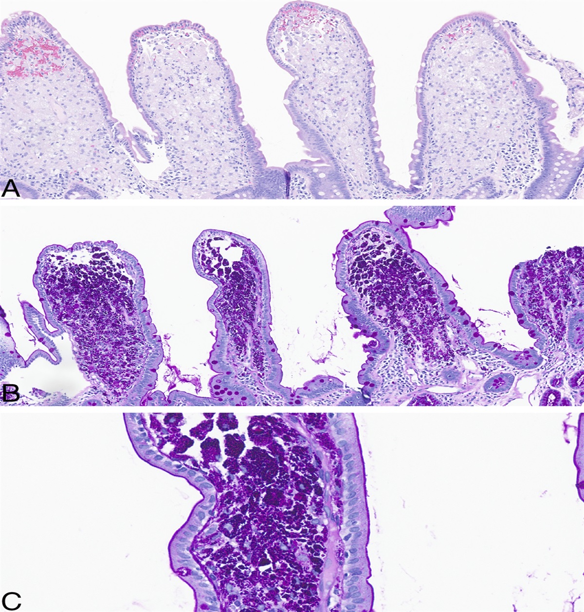 Whipple's Disease: A Textbook Disease That Is Often Missed in Real Life