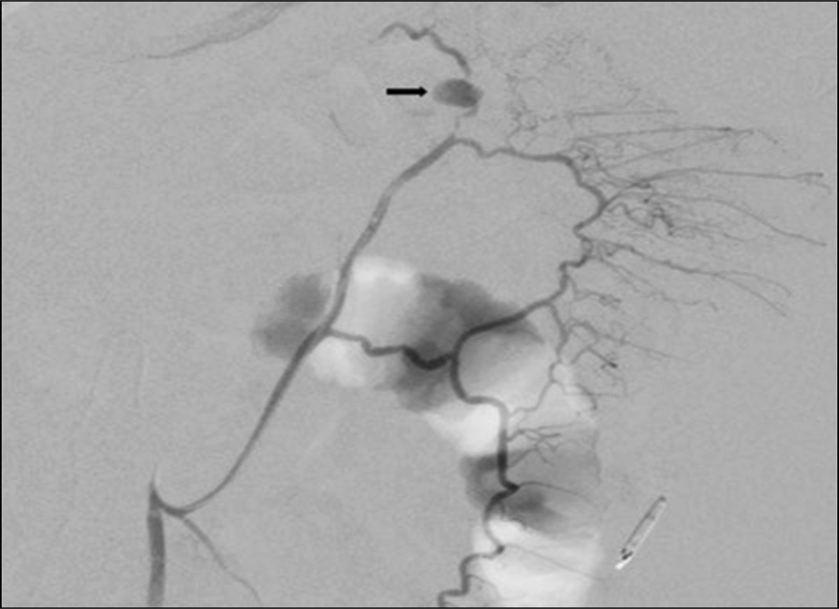 Marginal Artery of Drummond Masquerading as a Fistulous Tract Resulting in Recurrent Lower Gastrointestinal Bleeding