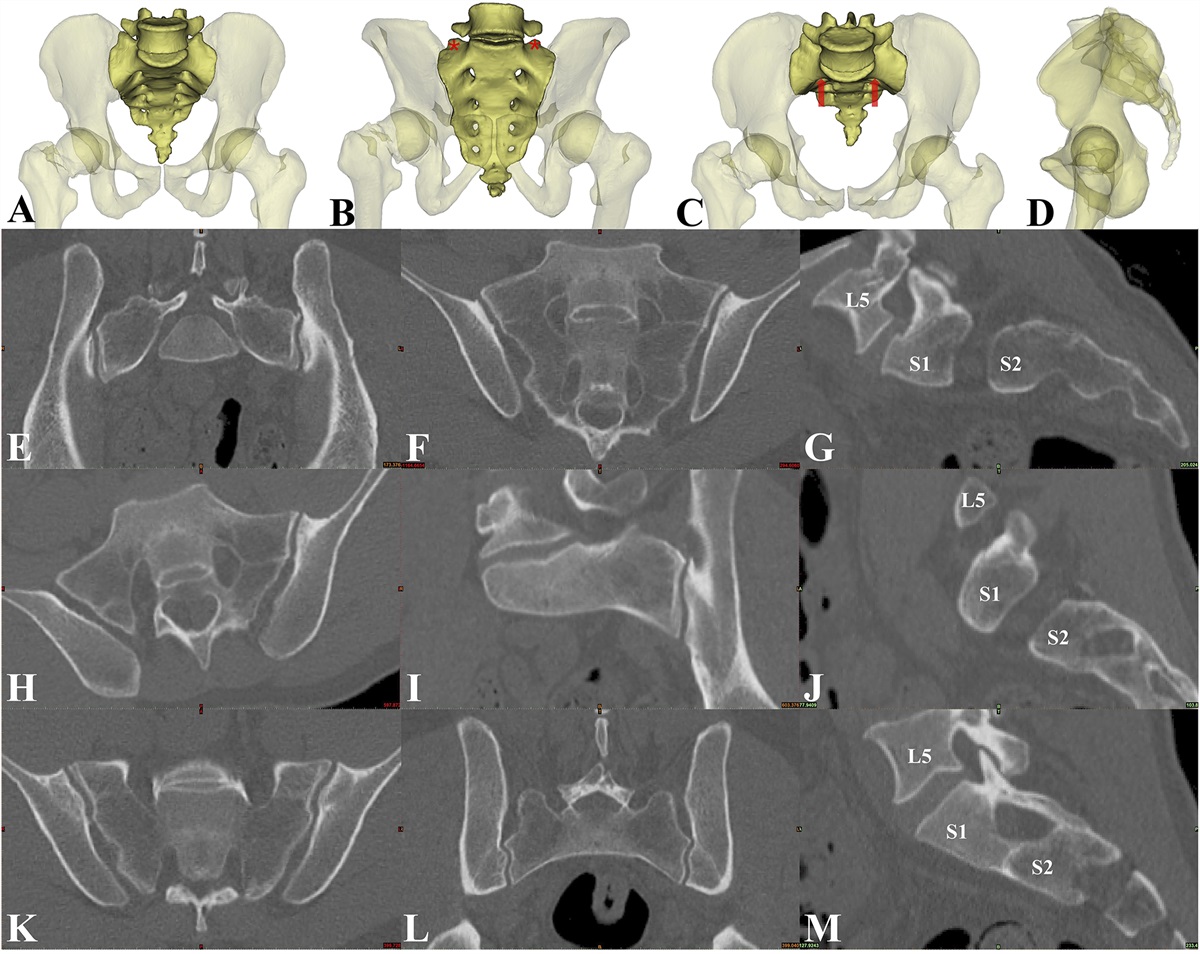 Specifying the Starting Point for S1 Iliosacral Screw Placement in the Dysmorphic Sacrum