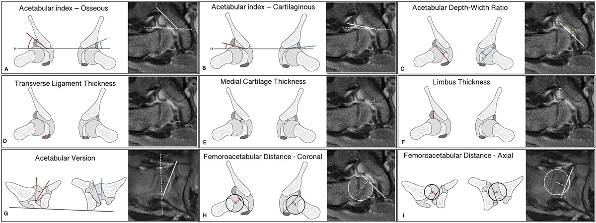 Hip Morphology on Post-Reduction MRI Predicts Residual Dysplasia 10 Years After Open or Closed Reduction