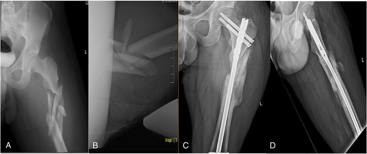 Atypical Versus Typical Subtrochanteric Femoral Fractures: Disparate Patient Profiles, Similar Outcomes