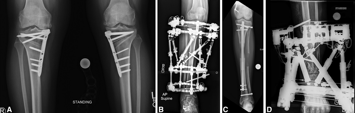 Avoiding Compartment Syndrome, Vascular Injury, and Neurologic Deficit in Tibial Osteotomy: An Observational Study of 108 Limbs
