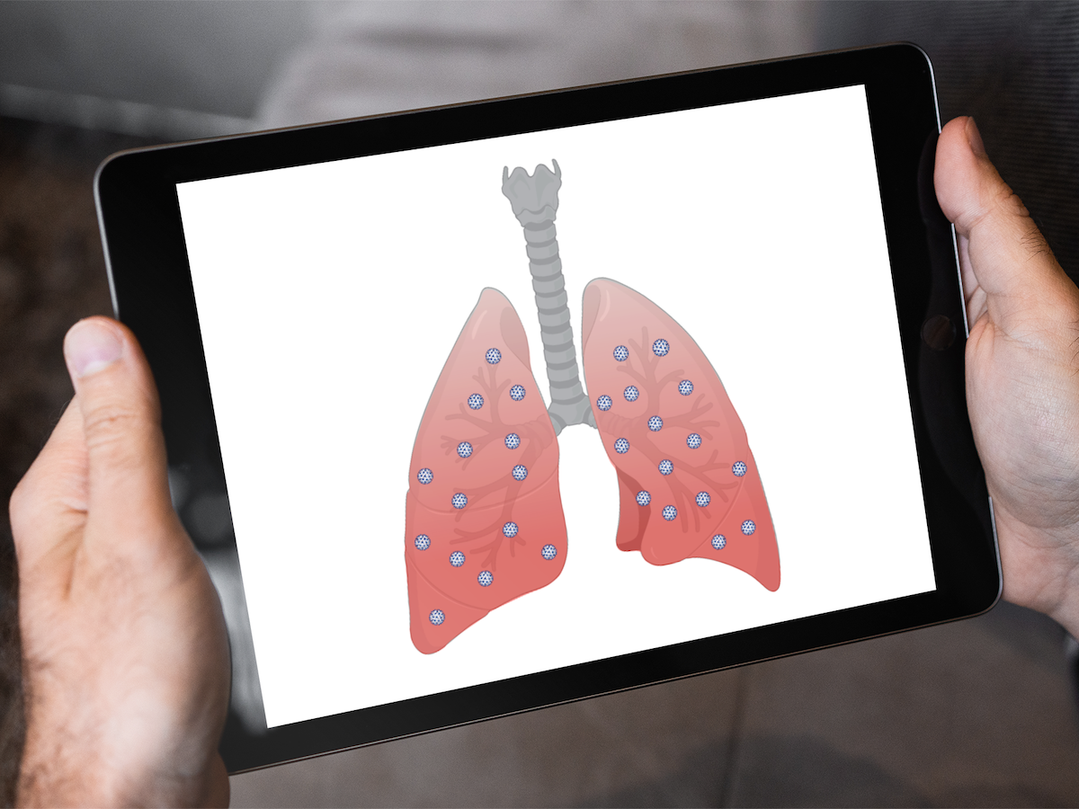 Airway Sequelae After Mechanical Ventilation for COVID-19: Protocol for a Scoping Review