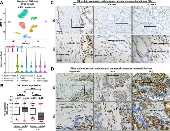 Glucocorticoid treatment influences prostate cancer cell growth and the tumor microenvironment via altered glucocorticoid receptor signaling in prostate fibroblasts