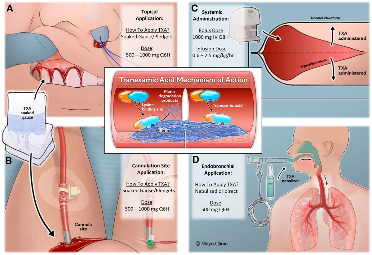 Tranexamic Acid for Bleeding Management in Adult Patients on Extracorporeal Membrane Oxygenation