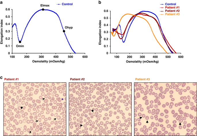 Red cell abnormalities characterized by ektacytometry in children with cholestasis
