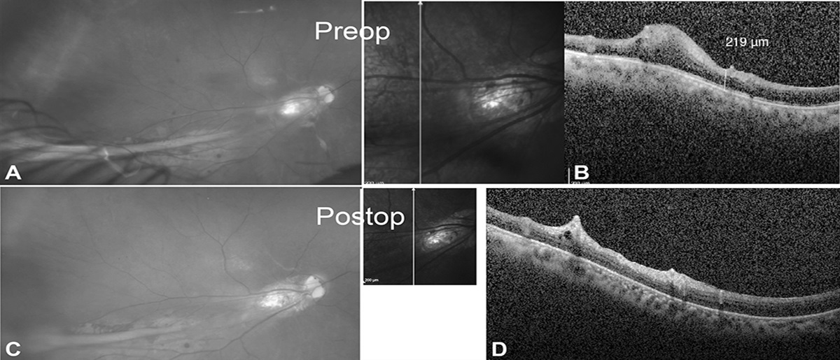 Combined Internal Limiting Membrane Peeling and Subretinal Balanced Salt Solution Injection: A Novel Technique to Unfold Congenital Falciform Folds