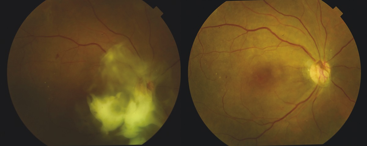 Intraocular Fibrin Glue to Lower the Risk of Postoperative Vitreous Hemorrhage After Diabetic Pars Plana Vitrectomy