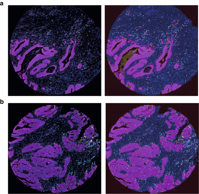 Opposing roles by KRAS and BRAF mutation on immune cell infiltration in colorectal cancer – possible implications for immunotherapy
