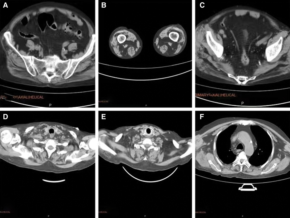 Rhabdomyolysis in a patient with end-stage renal disease and SARS-CoV-2 infection: A case report