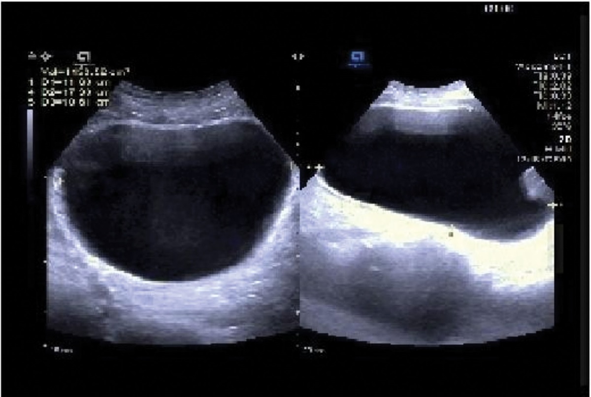 Acupuncture treatment of acute urinary retention caused by varicella-zoster virus through by combining the mechanism of sacral neuromodulation: A rare case report