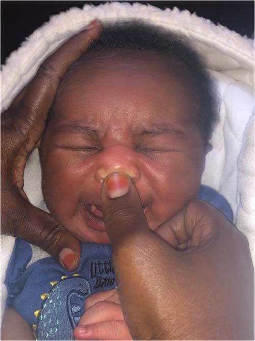 Antenatal jaundice instruction and acute bilirubin encephalopathy in Nigeria